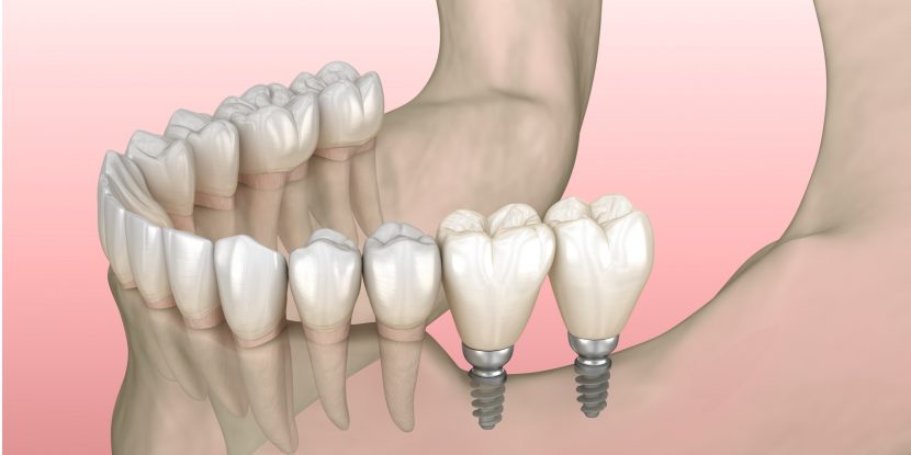 Schematische Darstellung von einem Implantat-Backenzahn
