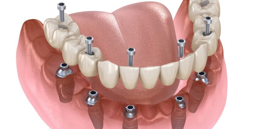 Wie viele Implantate man braucht, wenn alle Zähne fehlen, zeigt diese Grafik.