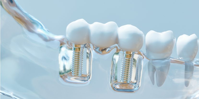 Zahnimplantat - Modell einer Zahnimplantation