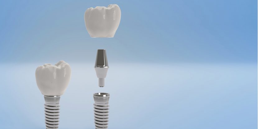 Zahnimplantat: Darstellung von Implantat, Abutment und Zahnkrone