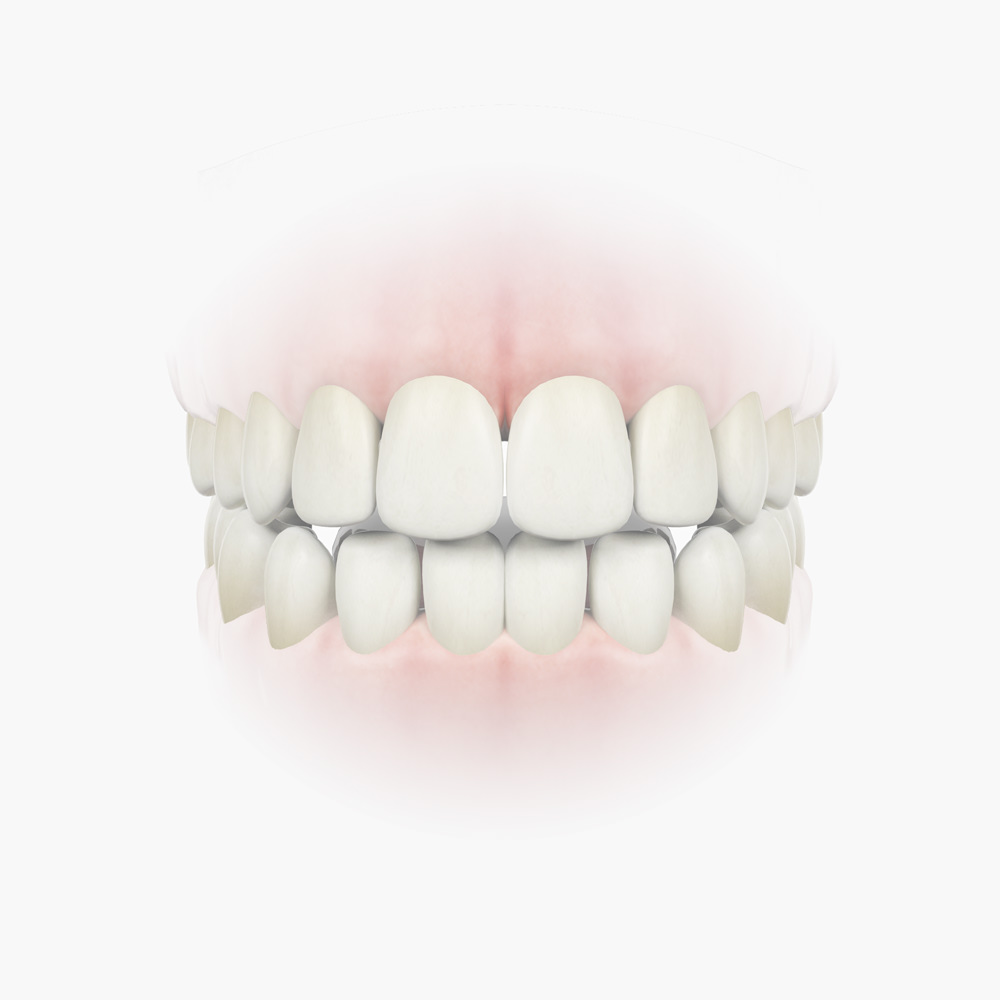 Zahnimplantat: Zahnschema zum Thema Implantat