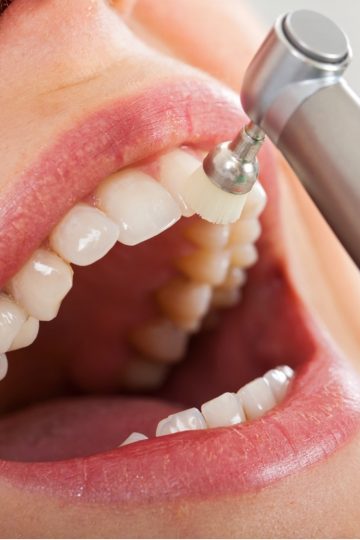 Professionelle Zahnreonigung-Klinik am Schloss