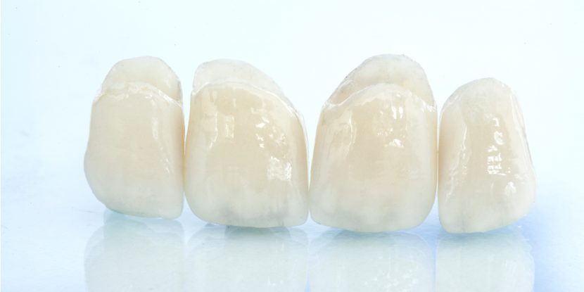 Dass bei Zahnersatz Vollkeramik erste Wahl ist, ist allgemein bekannt.